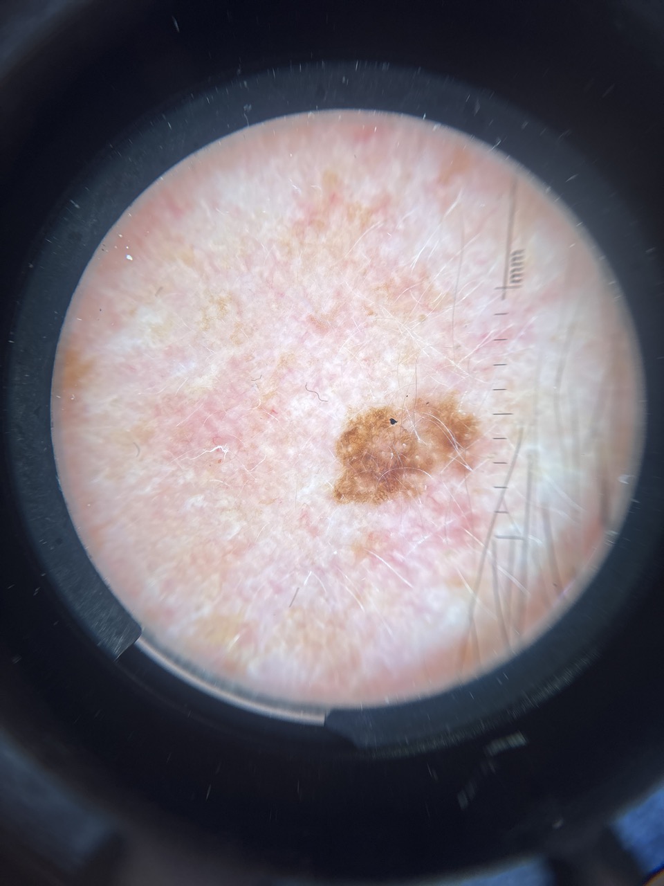 Image macroscopique d'une lésion cutanée suspecte.